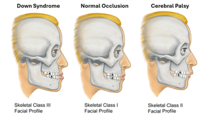 Jaw and bite patterns of persons with down syndrome and cerebral palsy as compared to normal occlusion.