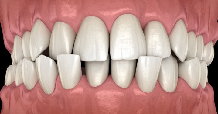 Anterior crossbite