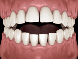 Open bite