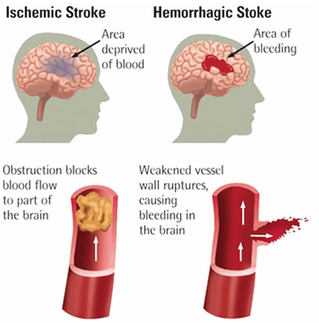 How Practice Helps the Brain Recover After a Stroke 2 Illustration on what are ischemic stroke and hemorrhagic stroke.