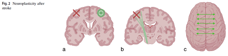 How Practice Helps the Brain Recover After a Stroke 3 Illustrations of a brain describing neuroplasticity after stroke.