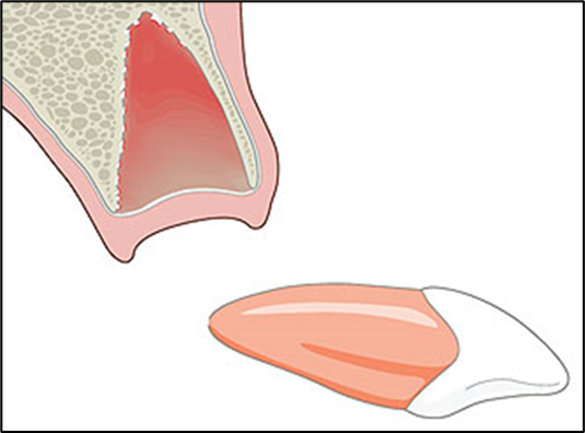 Illustration of a dislodged tooth