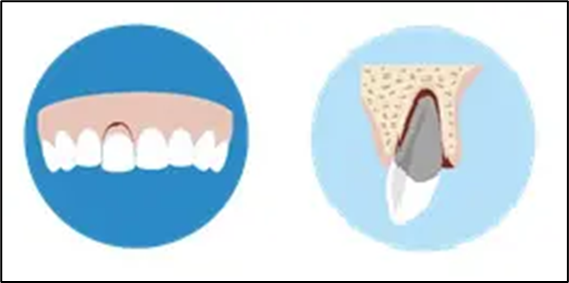 Illustration of a tooth displaced from the gum