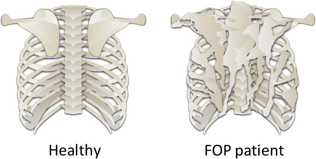 Comparison between healthy set of bones and a set with fibrodysplasia ossificans progressiva