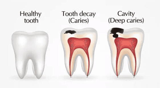 A picture showing a comparison of healthy tooth, tooth decay (caries), and cavity (deep caries)