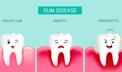 A picture showing the comparison between healthy gum, gingivitis, and periodontitis.