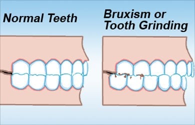 A picture showing a comparison of normal teeth and bruxism or tooth grinding.