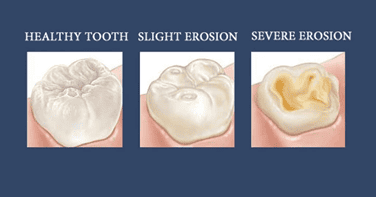 A picture showing the comparison of healthy tooth, tooth with slight erosion and tooth with severe erosion.