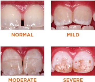 A picture showing the different levels of enamel hypoplasia.