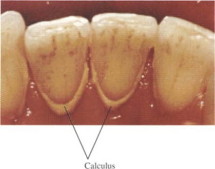 A picture showing teeth with calculus.