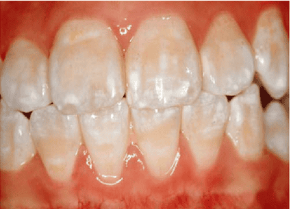 A photo showing enamel opacities in teeth.