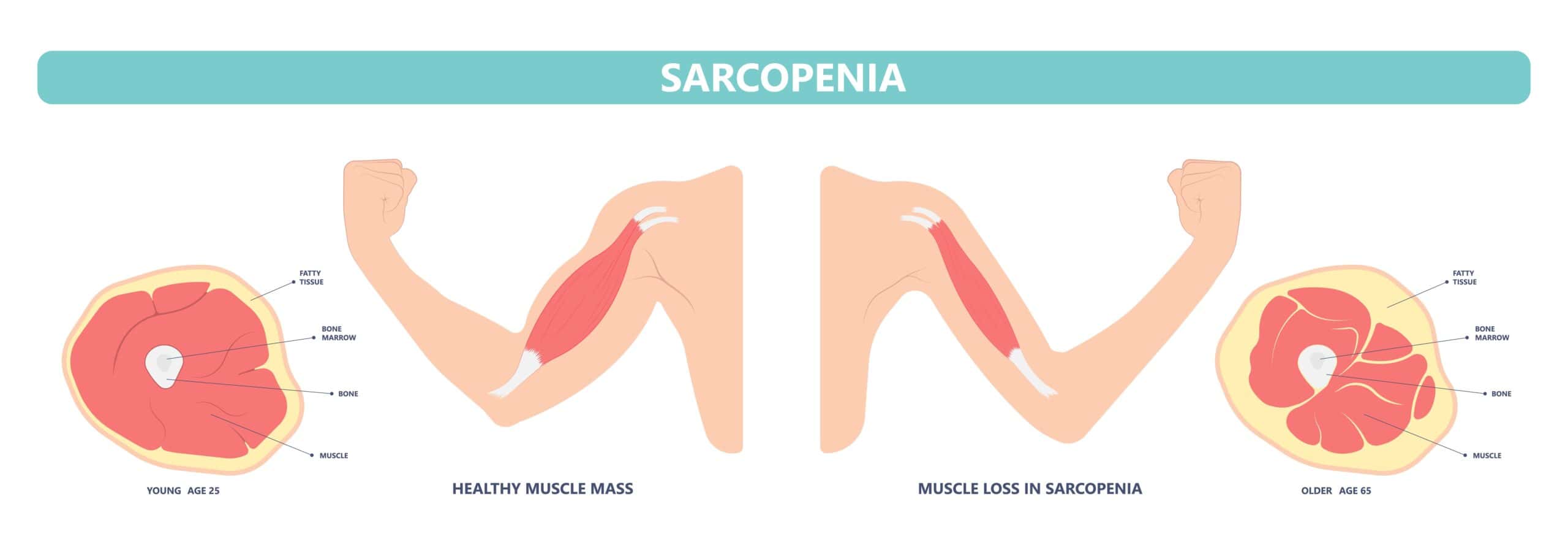 Illustration of healthy muscle mass vs muscle loss due to sarcopenia