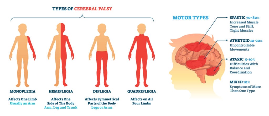 Cerebral palsy illustration on different types with information on motor types, associated impairments and treatment. 