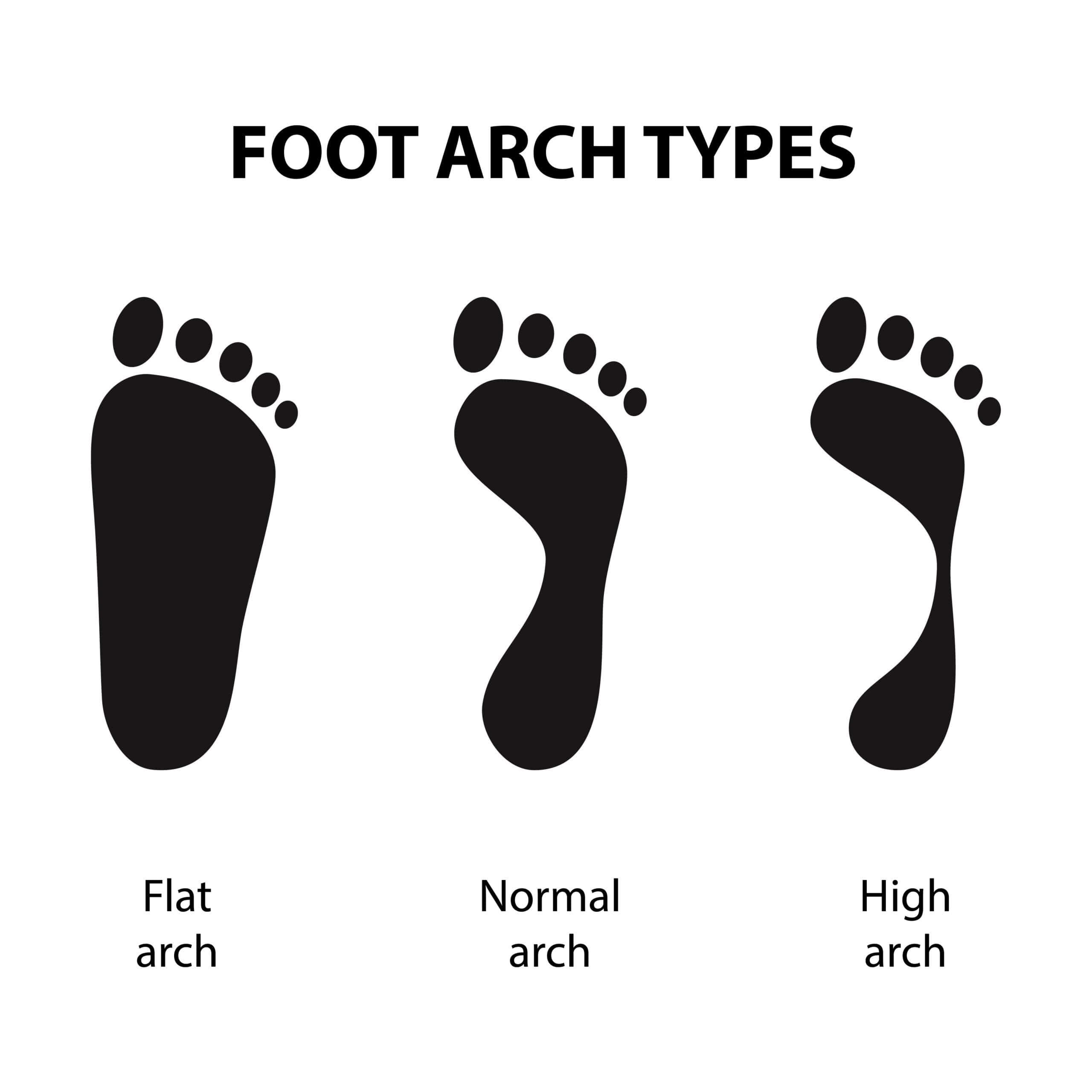 A photo showing the comparison of the three different foot arch types - flat arch, normal arch and high arch.