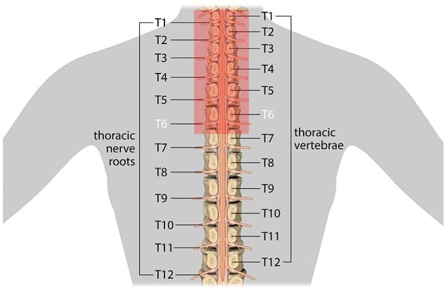 The different lesion levels with red highlights on T6 to T1 lesions