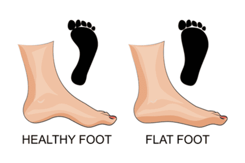 A picture showing the difference between healthy foot and flat foot. 